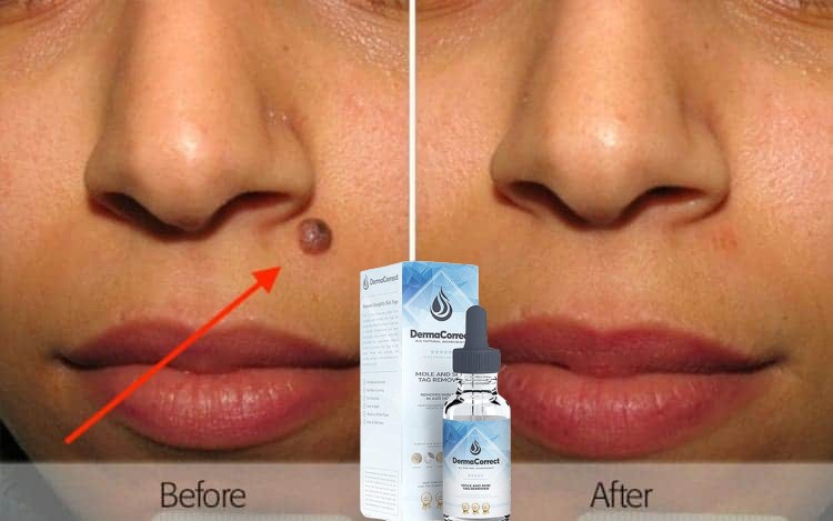 how to remove moles naturally in one day best way to remove skin tags